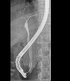 ERCP