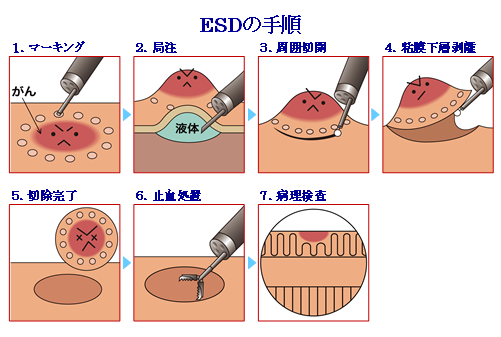 ESDの手順